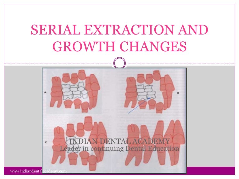 Serial extraction and growth changes / dental courses