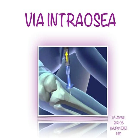 Sesion intraosea