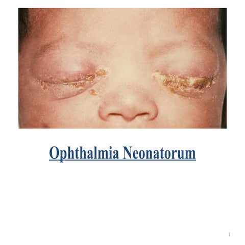 Session 5-Ophthalmikjdfa Neonatorum-1.pptx