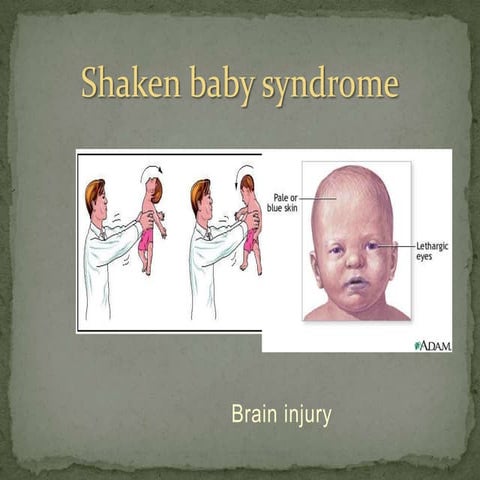 Shaken baby syndrome