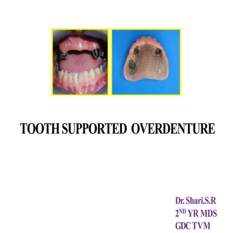 TOOTH SUPPORTED OVERDENTURE
