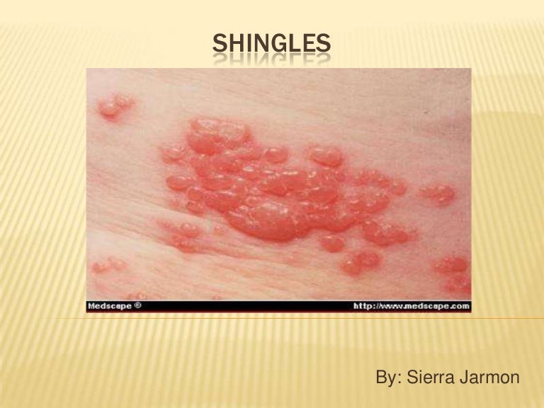 after effects of shingles inback