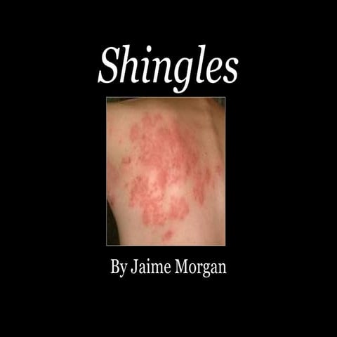 Shingles for human phys | PPT