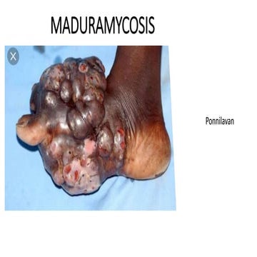 maduramycosis   