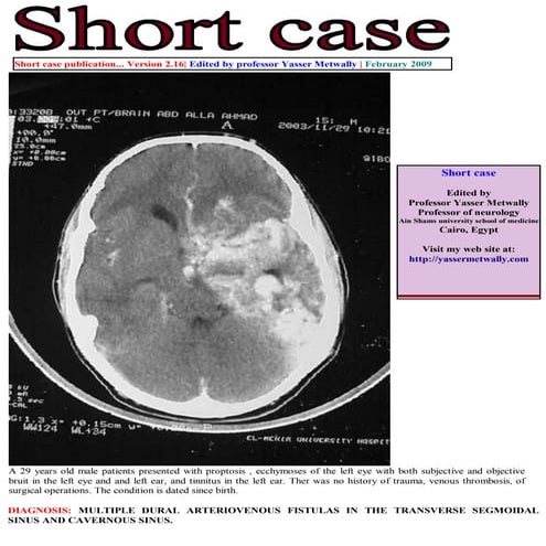Short case...Multiple dural arteriovenous fistulas