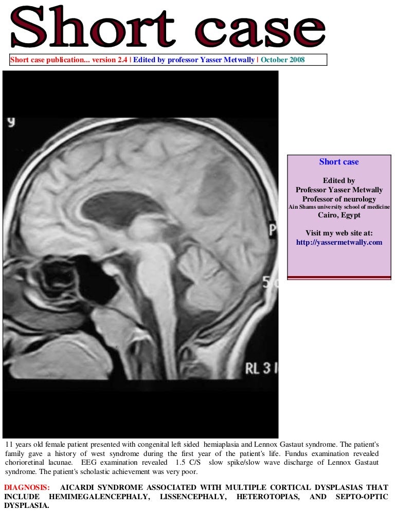 Short case&hellip;Aicardi syndrome