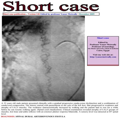 Short case...Spinal dural arteriovenous fistula