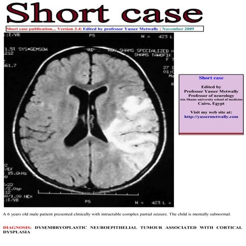 Short case...Dysembryoplastic neuroepithelial tumor