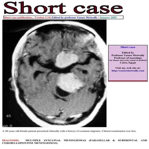 Short case...Multiple meningiomas