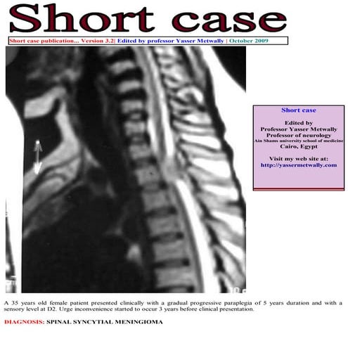 Short case...Spinal meningioma