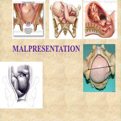 Shoulder presentation