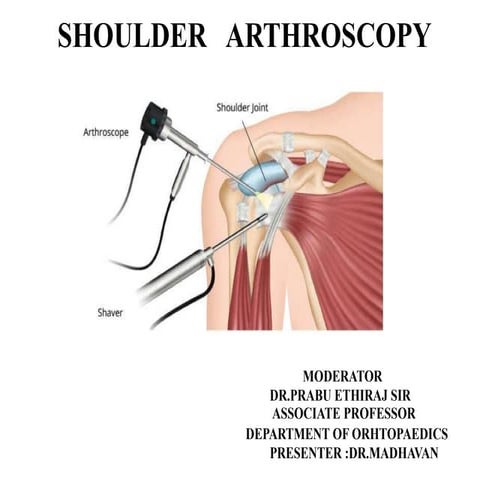 Shoulder arthroscopy