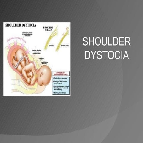 Shoulder dystocia