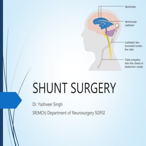 Shunt Surgery