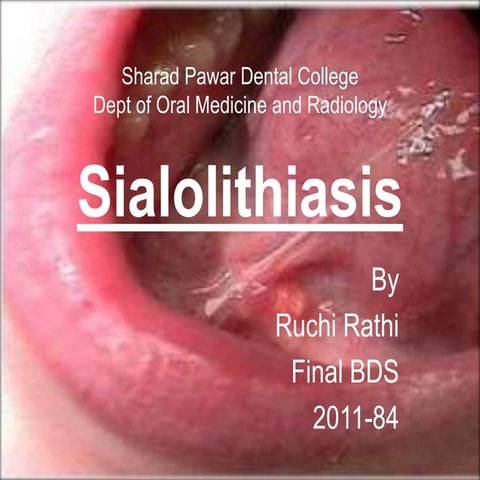 Sialolithiasis
