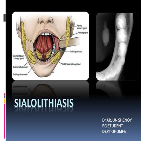 Sialolithiasis and its management in oral and maxillofacial surgery