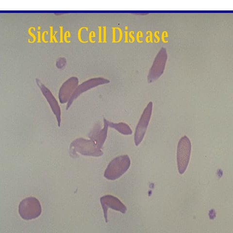 Sickle Cell Disease