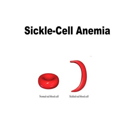 Sickle cell jj