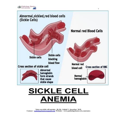 Sickle cell Anemia