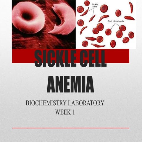 Sickle Cell Anemia