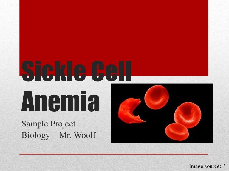 Sickle cell anemia