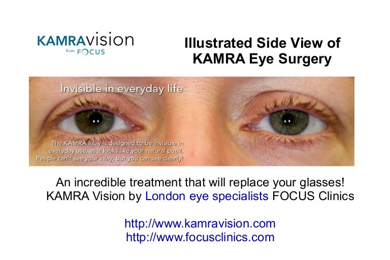 Side View Kamra Inlay Eye Surgery London UK