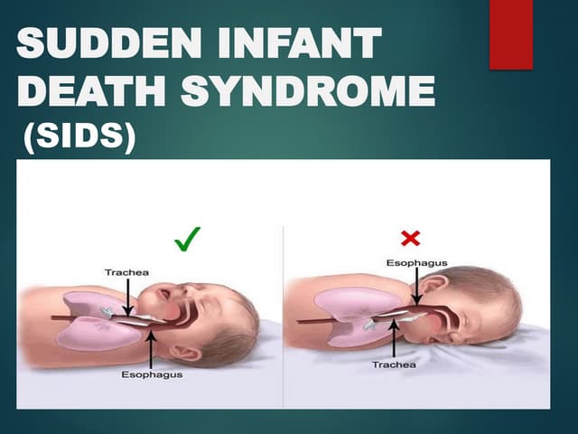 SIDS_Presentation ppt. This a short presentation on sudden infant death ...