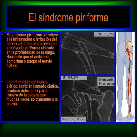 Sindrome del-piriforme
