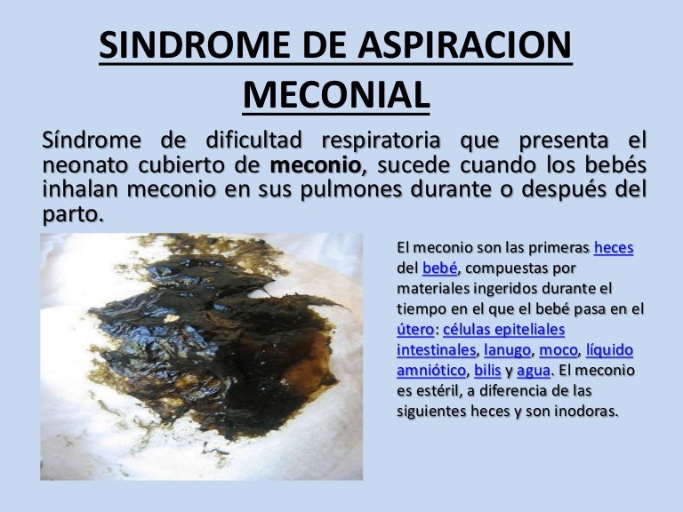Sindrome de aspiracion meconial