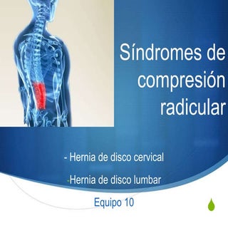 Sindrome de compresion radicular