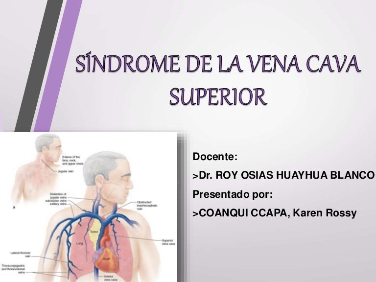 sindrome-de-la-vena-cava-superior