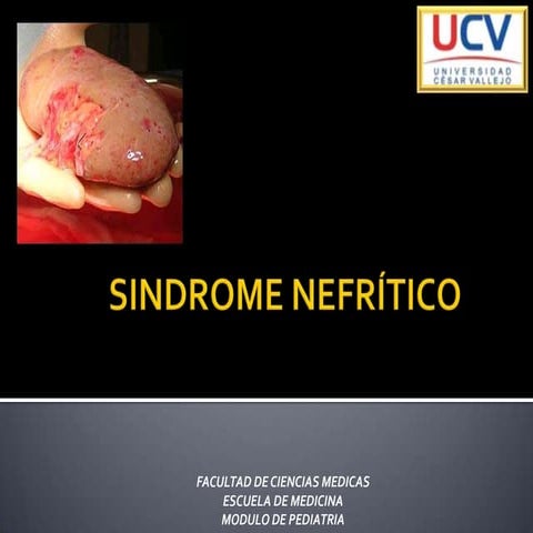 Sindrome nefritico