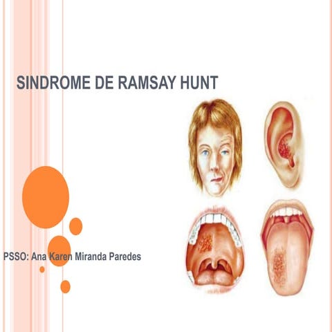 Wiki-Eintrag: Ramsay-Hunt-Syndrom – ZEXQ