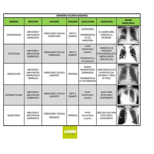 SÍNDROMES PLEUROPULMONARES.pdf