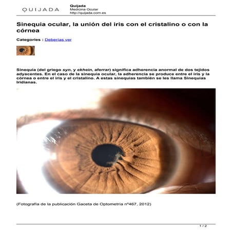 Sinequia ocular