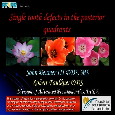 Single tooth defects in the posterior quadrants