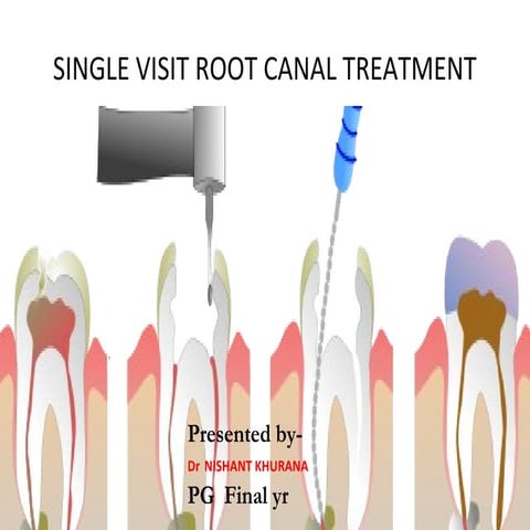 Single vs multiple visit endodontics | PPTX