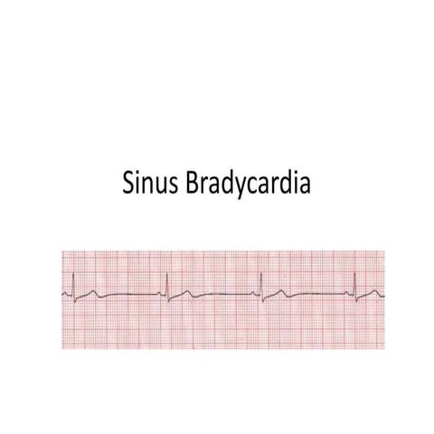Sinus bradycardia