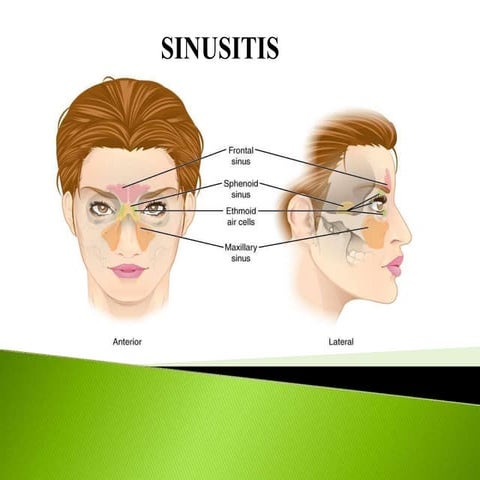 SINUSITIS (1).pptx