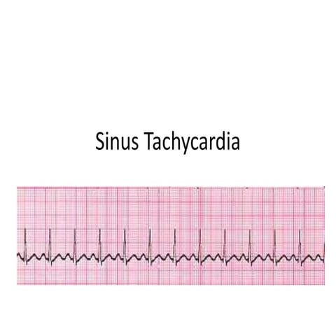 Sinus arrhythmia | PPTX