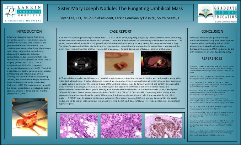 Sister mary joseph nodule differential diagnosis