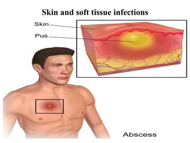 Skin and Soft Tissue Infections | PPTX