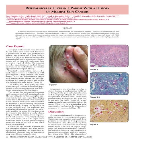 Skin Cancer Patient Ulcer Study by OC Skin Institute's Dr. Tony Nakhla