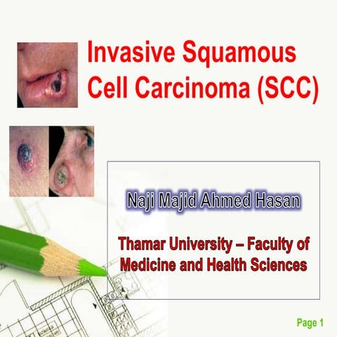 Squamous Cell Carcinoma (SCC)