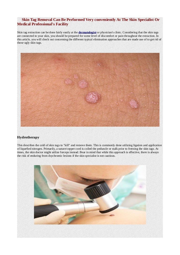 Skin tag removal can be performed very conveniently at the skin speci…