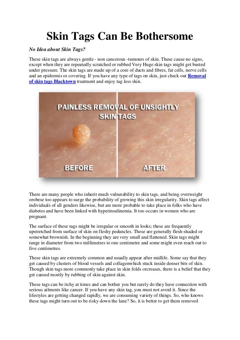 Skin tags can be bothersome