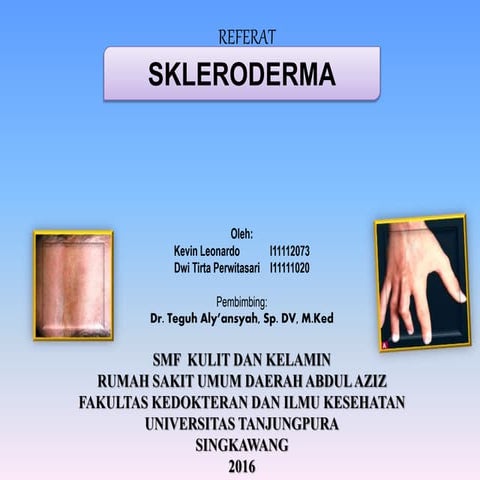 Skleroderma ppt