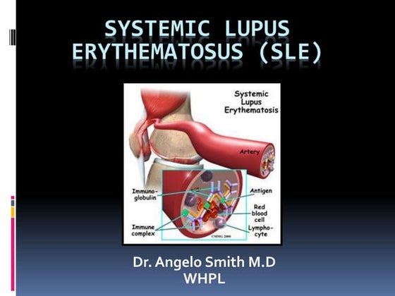 Systemic lupus erythematosus (SLE) | PPTX