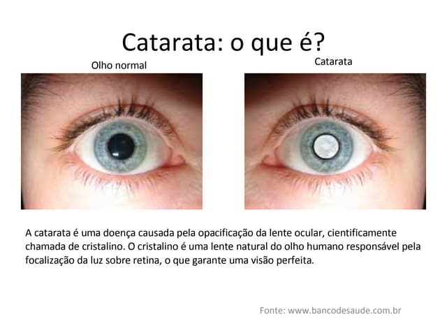 Slides sobre Catarata Ocular