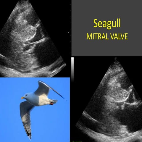 SEAGULL MITRAL VALVE 